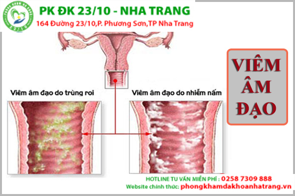 Viêm buồng trứng bệnh phụ khoa nguy hiểm