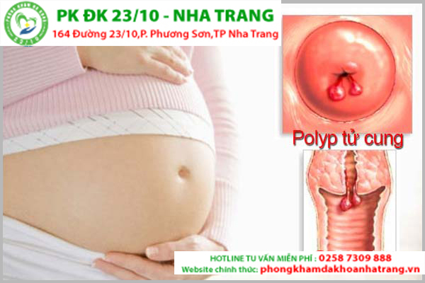 Những điều đáng chú ý về polyp cổ tử cung khi mang thai